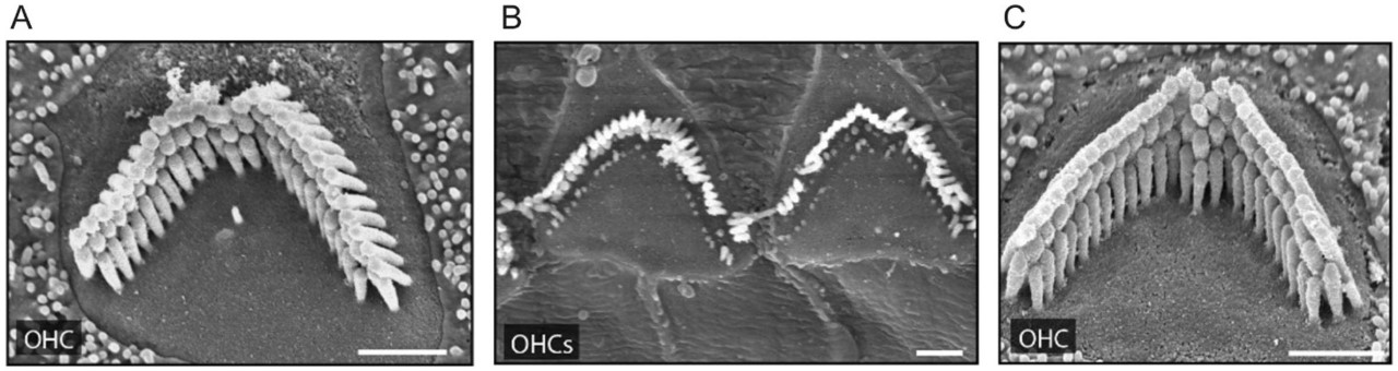 Preservation of hair cells in a mouse cochlea with mini-PCDH15 gene therapy